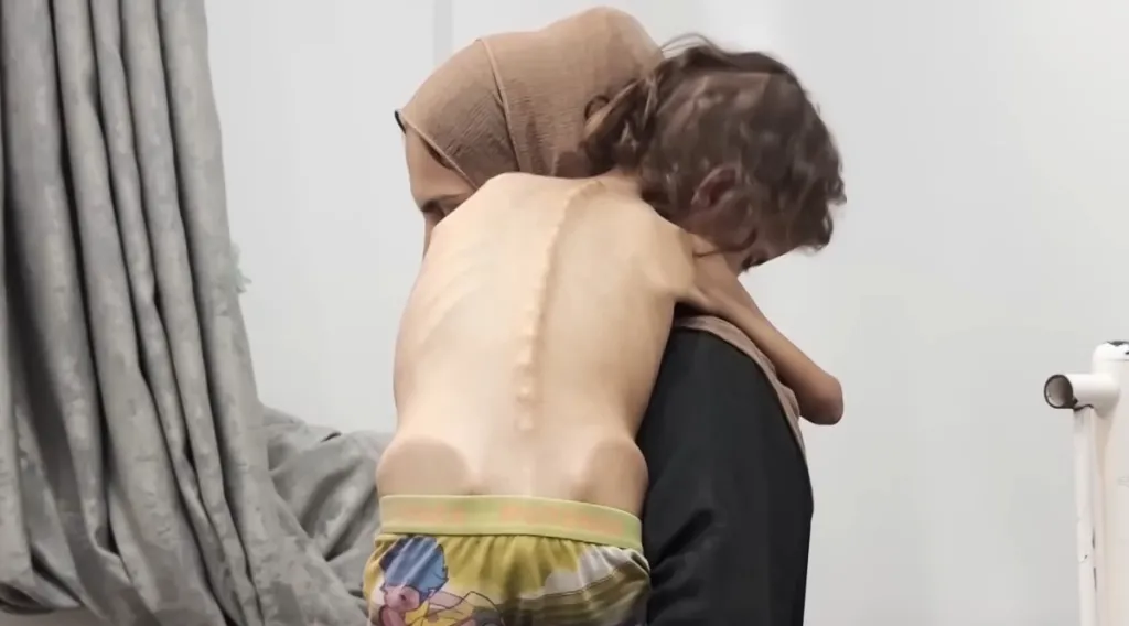 ഗാസയില്‍ അഞ്ചു വയസ്സിനുതാഴെയുള്ള 1,32,000 കുട്ടികള്‍ അതിഗുരുതരമായ പോഷകാഹാരക്കുറവ് നേരിടുന്നുവെന്നും 43,000- ലേറെ കുഞ്ഞുങ്ങള്‍ മരണത്തിലേക്ക് നീങ്ങുകയാണെന്നും യു.എന്‍ മുന്നറിയിപ്പുനല്‍കുന്നു.