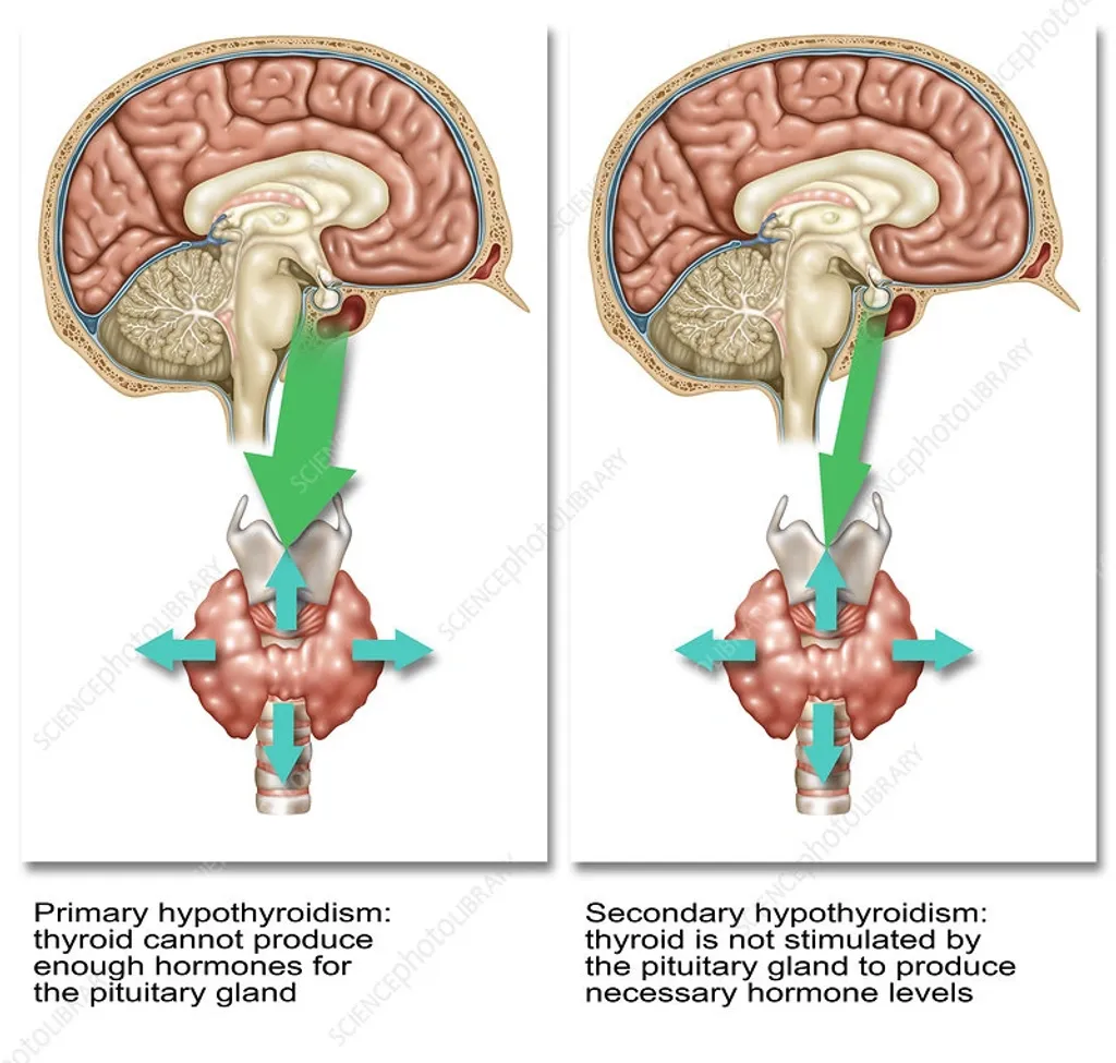 പ്രൈമറി തൈറോ ടോക്‌സിക്കോസിസ് പ്രധാനമായി മനസിനേയും തലച്ചോറിനേയും ബാധിക്കുമ്പോൾ സെക്കൻഡറി തൈറോടോക്‌സിക്കോസിസ് ഹൃദയത്തെ ബാധിക്കുന്നു.