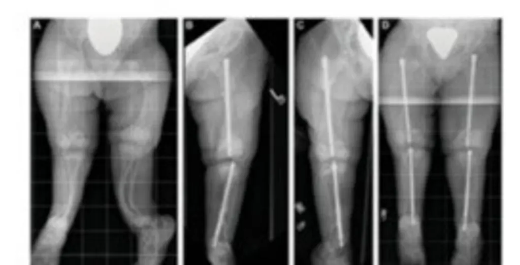 നെയിൽ (Intramedullary nail) (fig 3. a,b,) 