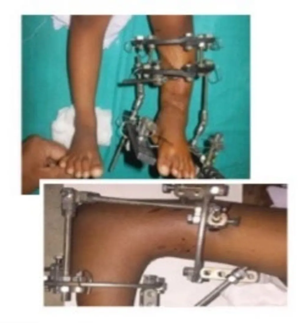 ഇലിസാരോവ് Fig 5.(a,b,) 