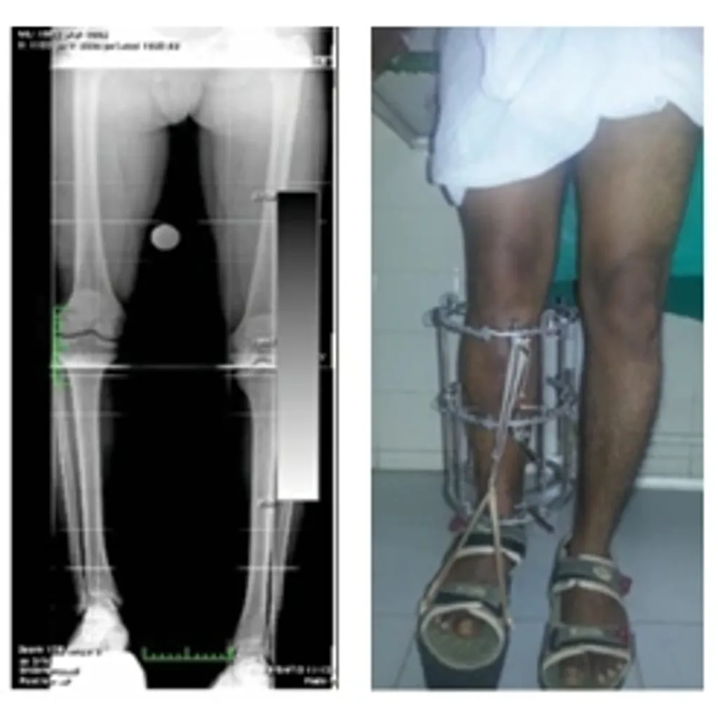 (a,ശസ്ത്രക്രിയയ്‌ക്ക് മുൻപുള്ള പൂർണ്ണനീള എക്സ്-റേ – b,ഫ്രെയിം ഘടിപ്പിച്ചശേഷമുള്ള ചിത്രം : Fig 8 a,b) 