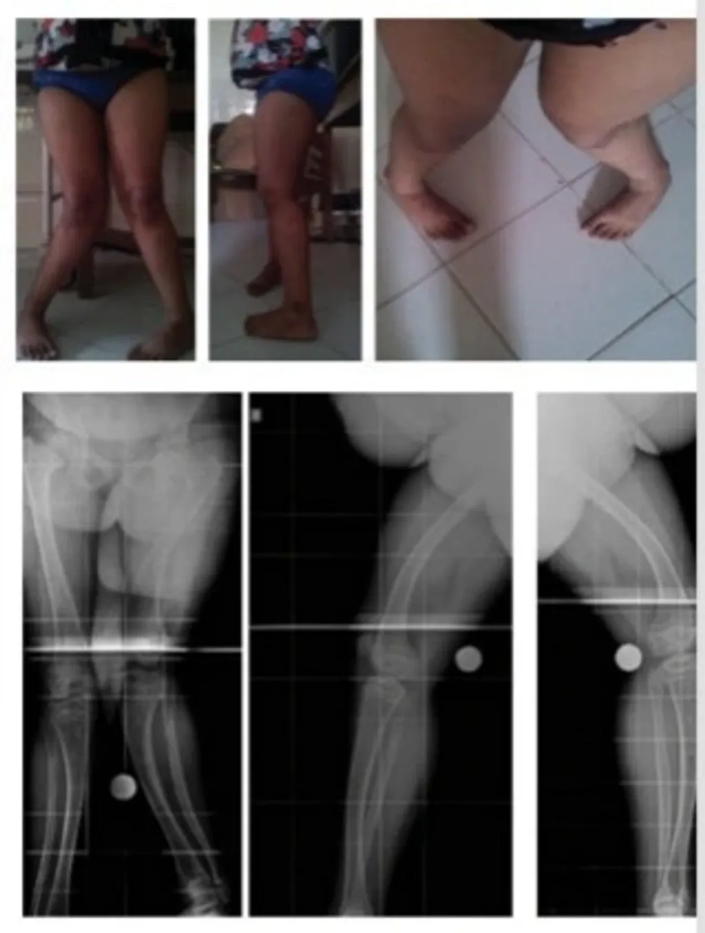 രണ്ടാമത്തെ രോഗി 13 വയസ്സുള്ള ഒരു പെൺകുട്ടിയായിരുന്നു. ഇരുകാലുകളിലും അതിതീവ്രമായ വളവ് ഉണ്ടായിരുന്ന അവൾ, പല സ്ഥലങ്ങളിൽ ചികിത്സ തേടിയിരുന്നു. (Fig 10 a,b,c,d,e,f) 