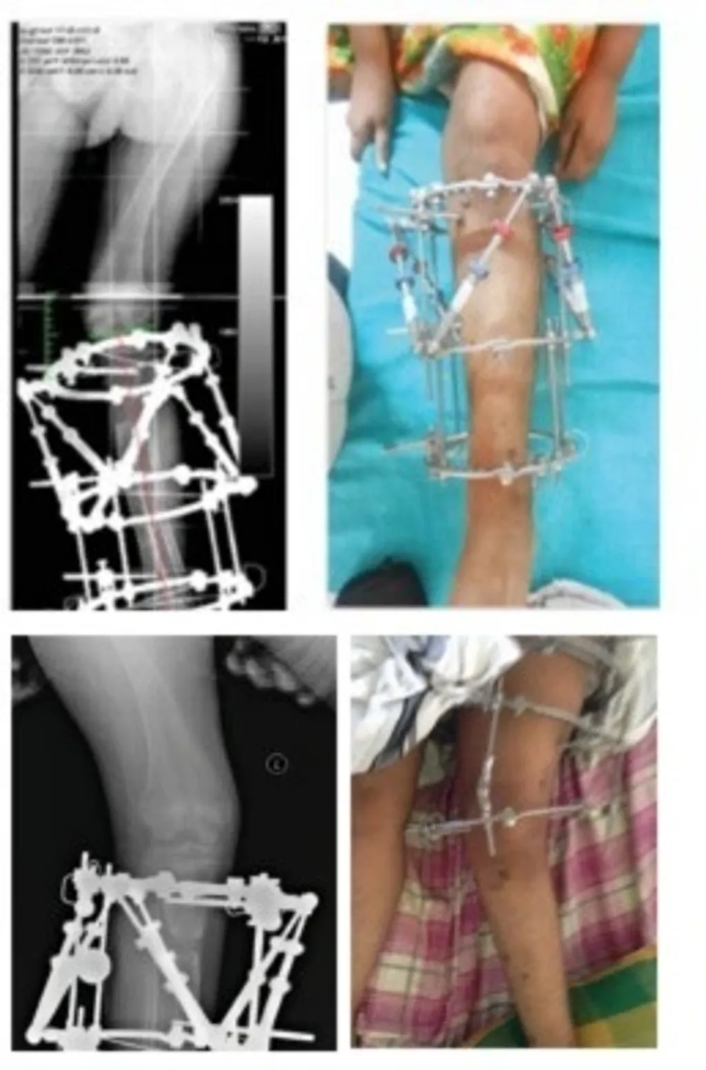 അസ്ഥിയുടെ അവസ്ഥ മെച്ചപ്പെടുത്തിയതിന് ശേഷം ഇലിസാരോവ് ഫ്രെയിം ഉപയോഗിച്ച് ചികിത്സ ആരംഭിച്ചു (Fig 11 a,b,c,d). 