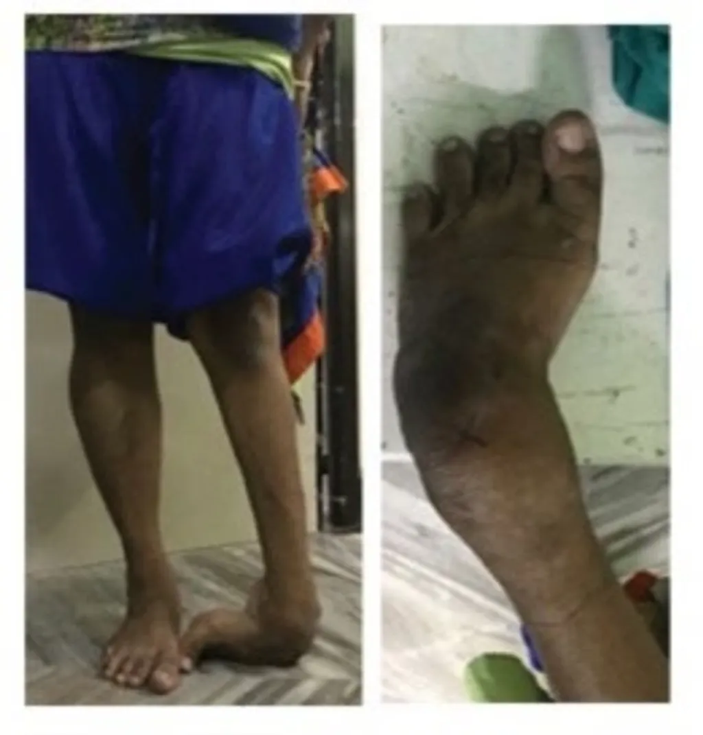 CTEV (ക്ലബ് ഫൂട്ട്) (Fig 13 a,b,c). 