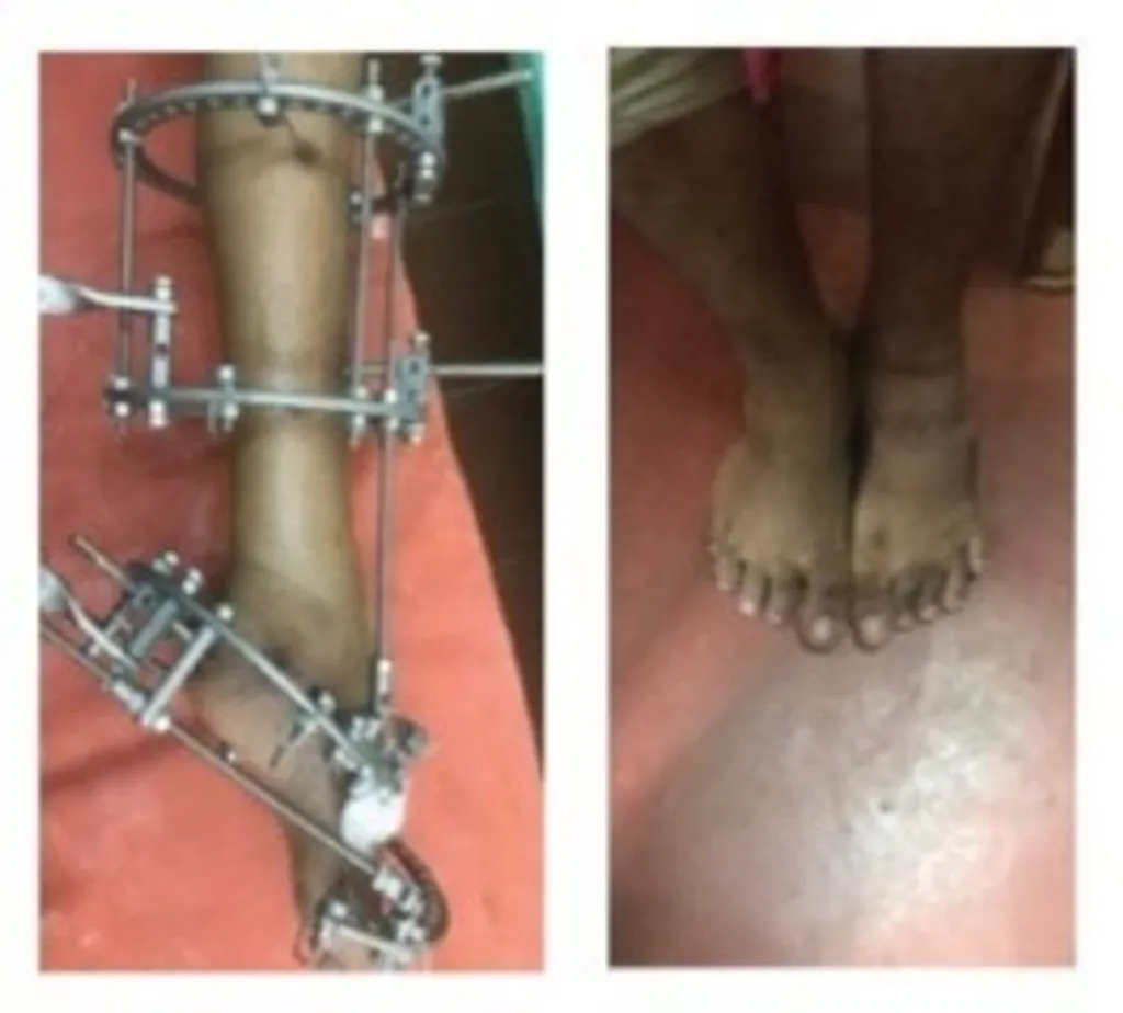 ഇലിസാരോവ് ഫ്രെയിം ഘടിപ്പിച്ച് ക്രമാനുസൃത പരിഹാരം നടത്തിയതോടെ, അവളുടെ കാൽ വൈകല്യം വിജയകരമായി ശരിയായി (Fig 14 a,b,c,d,).