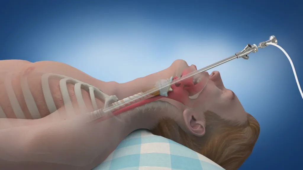 ബ്രോങ്കോസ്കോപി