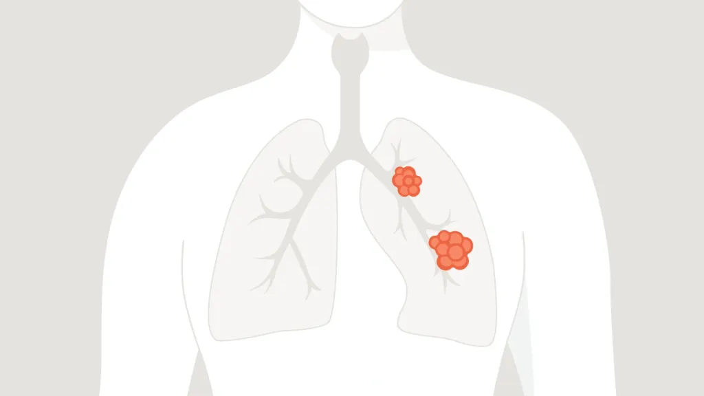ശ്വാസകോശ കാൻസറുകളിൽ കൂടുതലും NSCLC  ആണ്. ഏതുതരം കാൻസർ ആണെങ്കിലും തുടക്കഘട്ടങ്ങളിൽ മാത്രമേ സർജറി പ്രയോജനം ചെയ്യുകയുള്ളൂ. 