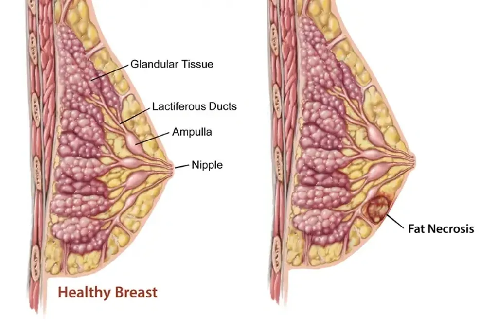 ക്ഷതങ്ങൾ കാരണം ഉണ്ടാകാവുന്ന മുഴകൾ മാറിൽ കാണാവുന്ന കാൻസർ അല്ലാത്ത മറ്റൊരു തരം മുഴകൾ ക്ഷതം കാരണം ഉണ്ടാകുന്നവയാണ്. കൊഴുപ്പ് കട്ടി പിടിച്ചുണ്ടാകുന്ന Fat Necrosis  ഇത്തരത്തിൽ ഒന്നാണ്. 