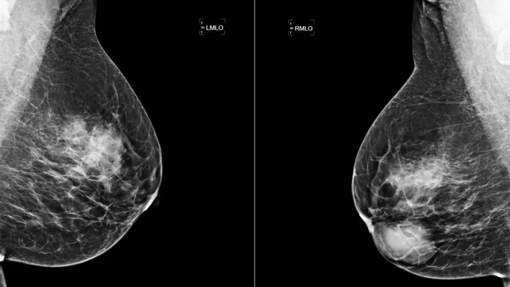 പെൺകുട്ടികളിലും യുവതികളിലും മാറിൽ കാണുന്ന, വേദനയില്ലാത്ത മുഴകൾ പലപ്പോഴും ഫൈബ്രോ അഡിനോമ (Fibro adenoma) ഗണത്തിൽപെട്ടവ ആയിരിക്കും. 