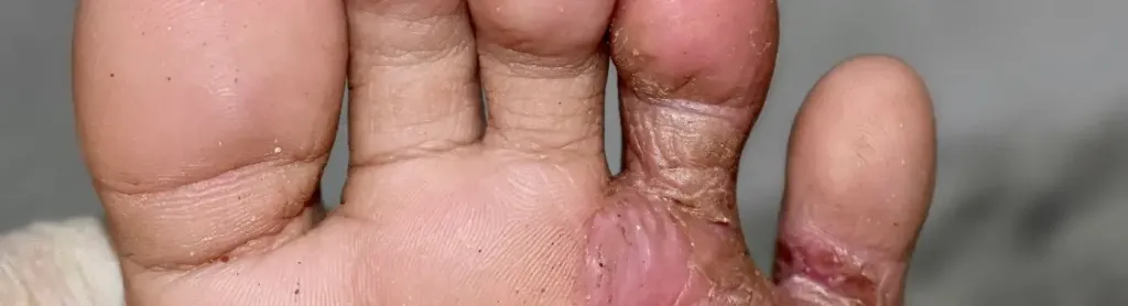 ടീനിയ പെഡിസ്. കാൽപാദങ്ങളിലുണ്ടാകുന്ന ഫംഗസ് ബാധ. ഏറ്റവും കൂടുതൽ കാണുന്ന രോഗമാണ് കാലിൽ വരുന്ന ഫംഗസ്ബാധ. 