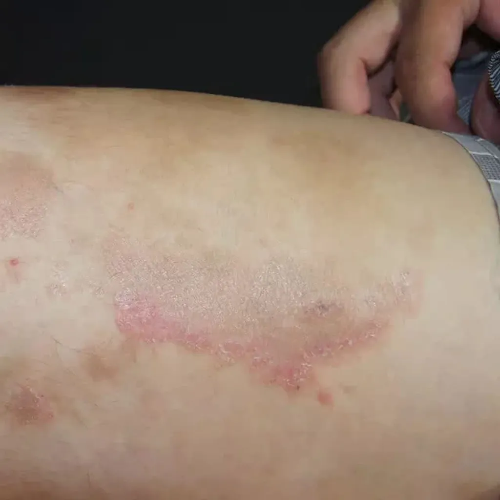 ടീനിയ കോർപോറിസ്. ചിലരിൽ ഇത് അസഹ്യമായ ചൊറിച്ചിലുണ്ടാക്കും. ചിലർക്ക് അത് അത്ര ഗൗരവതരമാകണമെന്നില്ല.